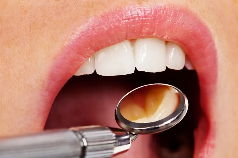 Close-up dental exam with a mouth mirror